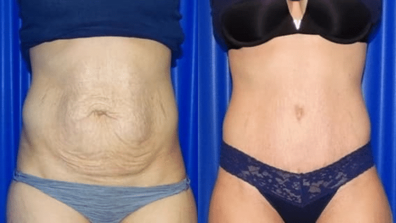 tummy tuck in london