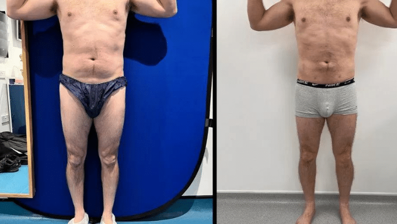 male calf implant results before and after case 1