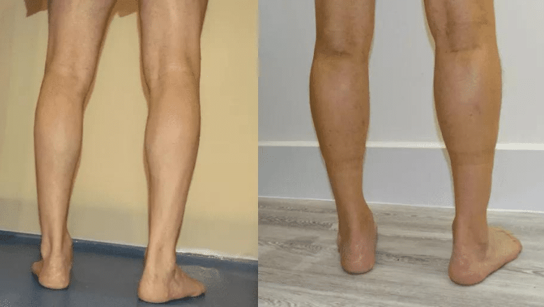 bilateral male calf augmentation before and after case 4