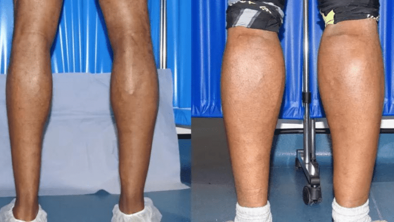 bilateral male calf implants before and after case 6