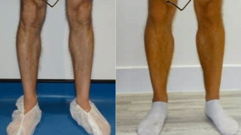 bilateral male calf implants before and after case 3