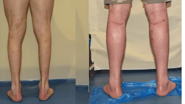 calf augmentation implants before and after case 8