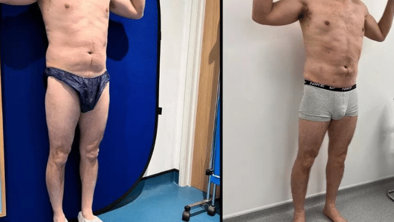 male calf implant results before and after case 1 view 2
