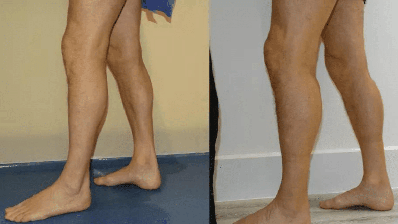 bilateral male calf augmentation before and after case 4 view 2