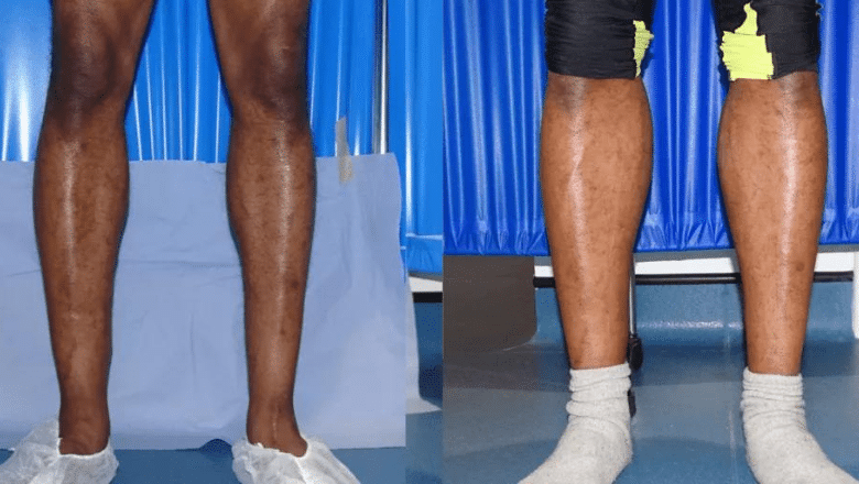 bilateral male calf implants before and after case 6 view 2