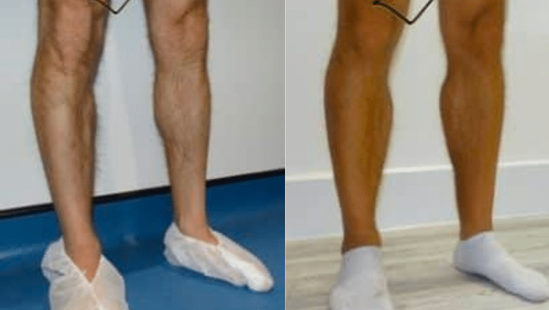bilateral male calf implants before and after case 3 view 2