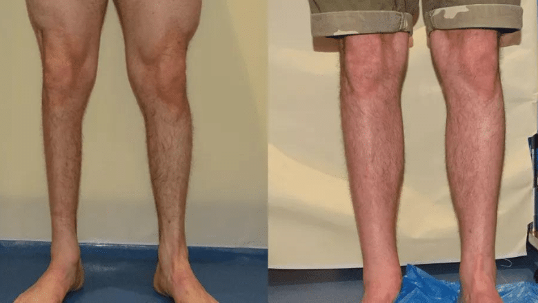 calf augmentation implants before and after case 8 view 2