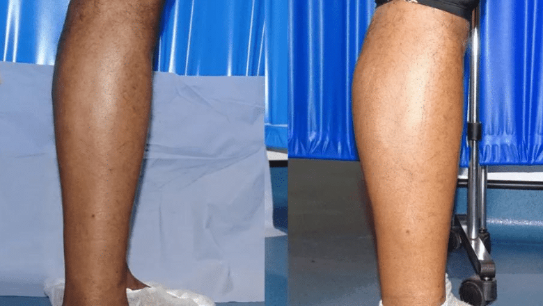 bilateral male calf implants before and after case 6 view 3