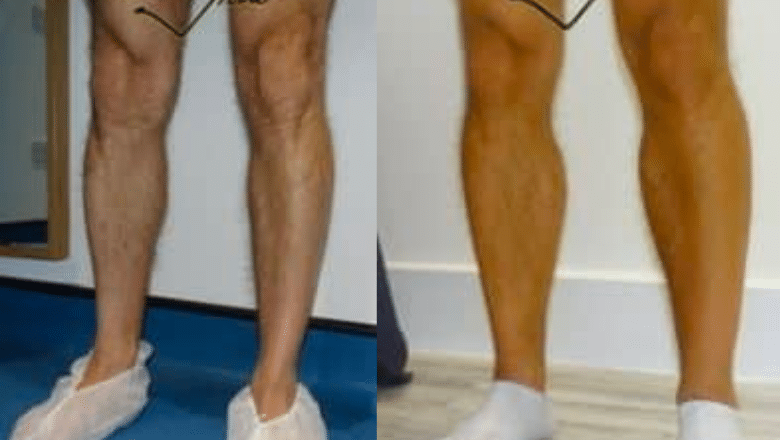 bilateral male calf implants before and after case 3 view 3