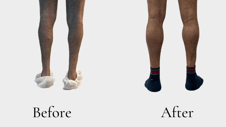 calf augmentation with implants before and after case 10 view 4
