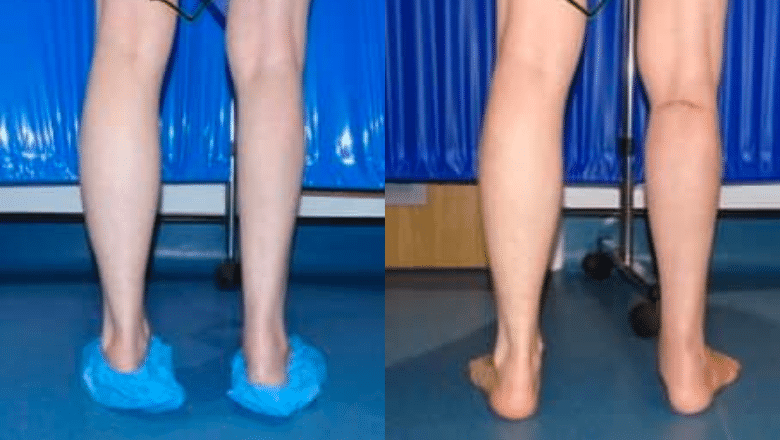 calf implant surgery London before and after case 10
