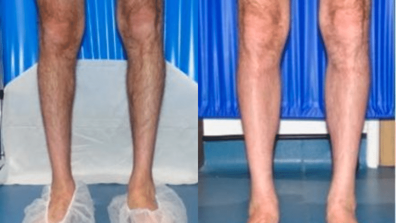 calf implants before and after case 7