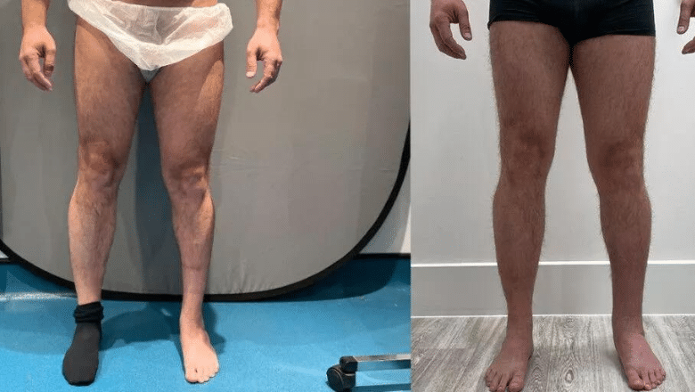 left calf augmentation before and after