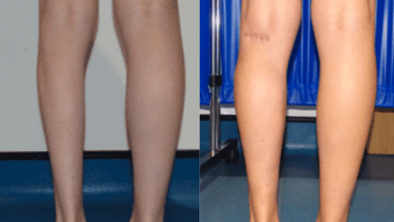 left calf augmentation implants before and after case 9
