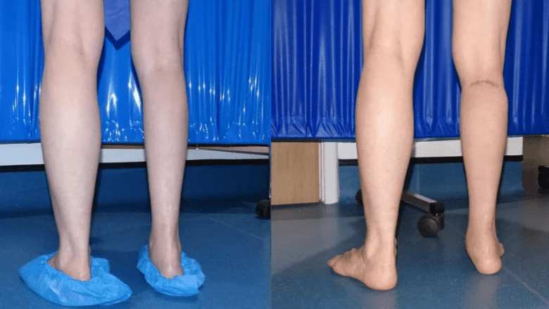 right calf augmentation implants before and after case 10 view 2