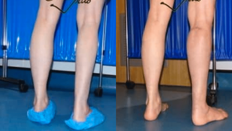 right calf augmentation implants before and after case 10 view 3