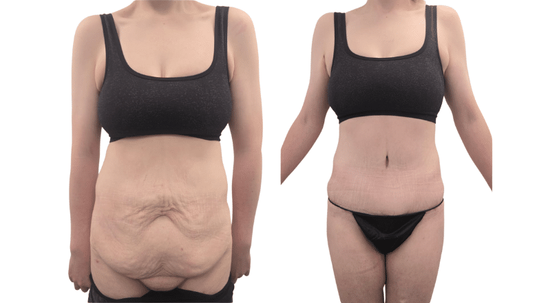 tummy tuck before after results