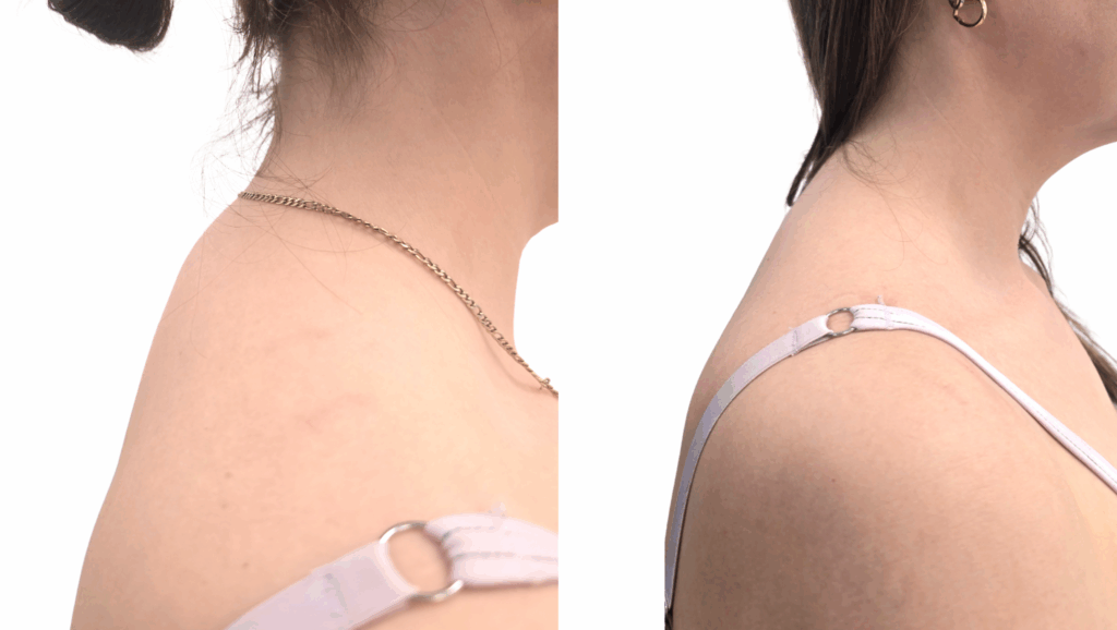 Buffalo Hump Removal