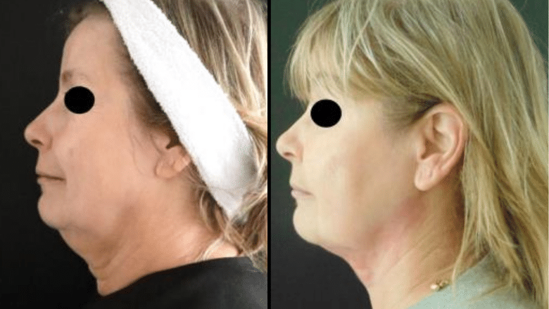 Morpheus8 and FaceTite combined before and after — CFS London