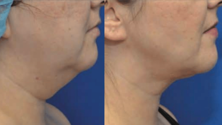 Morpheus8 face before after photo 1 — Centre for Surgery patient