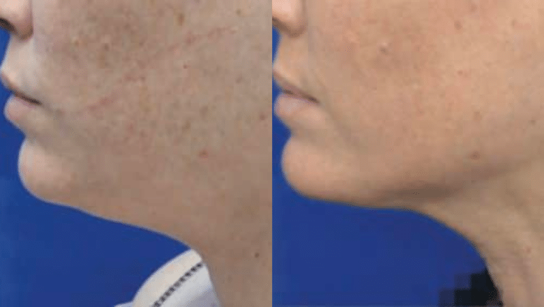 Morpheus8 face before after photo 2 — Centre for Surgery patient