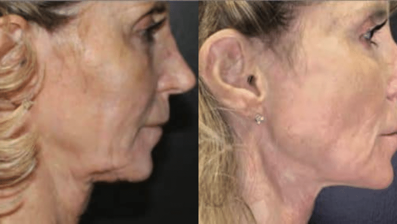 Morpheus8 face before after photo 3 — Centre for Surgery patient