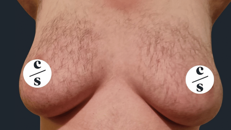 double incision top surgery before case 3