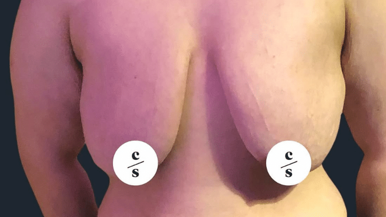 FTM top surgery before case 4