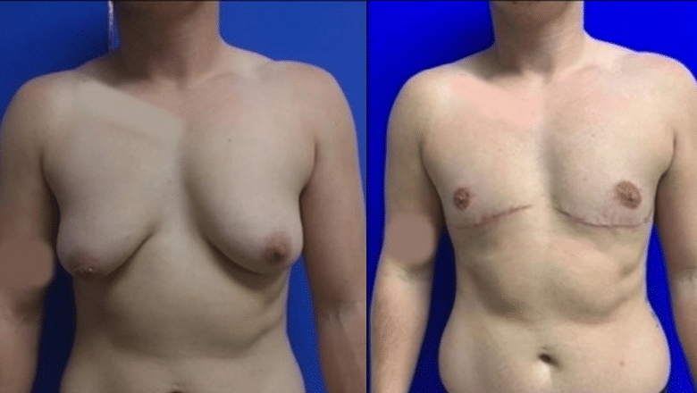 double incision top surgery before and after case 5 view 1