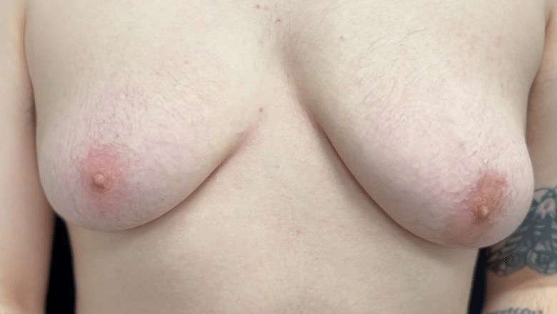 double incision top surgery before and after case 2