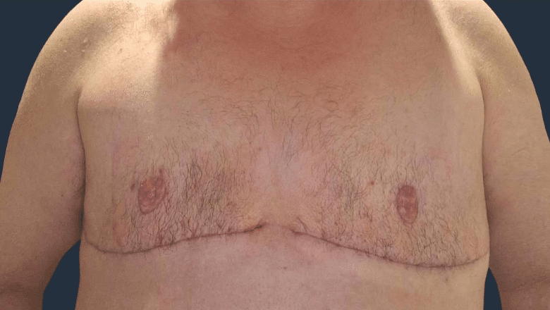 double incision top surgery after case 3