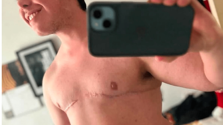 FTM top surgery after case 4