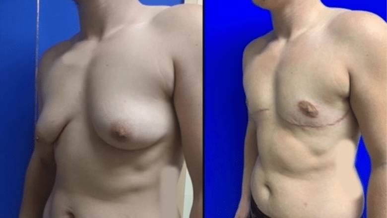 double incision top surgery before and after case 5 view 2