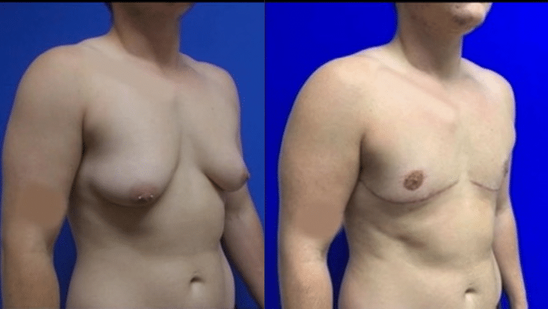 double incision top surgery before and after case 5 view 3
