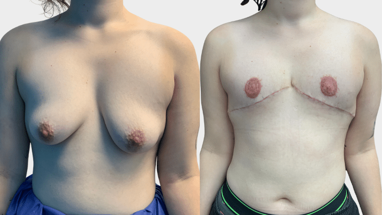double incision mastectomy with nipple grafting before and after