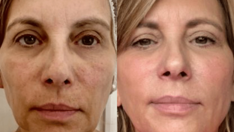 Fotona 4D before and after — patient result at Centre for Surgery, London
