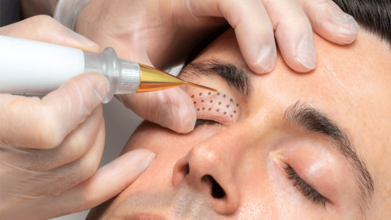 Laser eyelid tightening London — SmoothEye