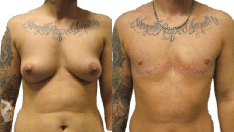double incision mastectomy before and after London