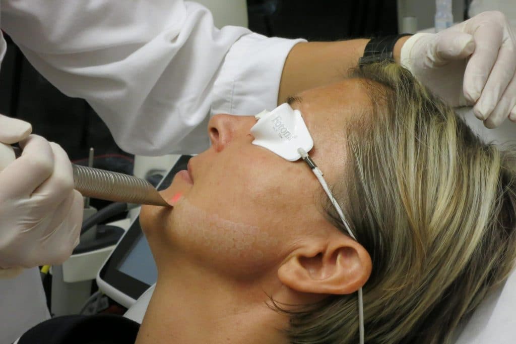 Fotona 4D Step 4 — SupErficial cold Er:YAG micro-peel