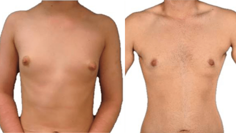 FTM periareolar mastectomy before and after