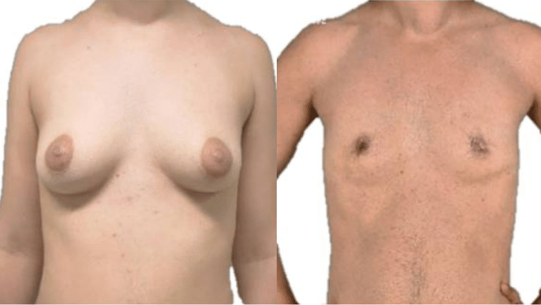 keyhole top surgery before and after London