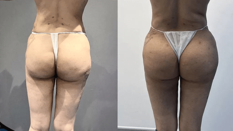 BBL before and after case 20