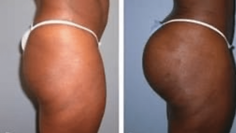 BBL before and after case 11