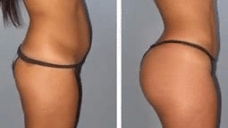 BBL before and after case 14
