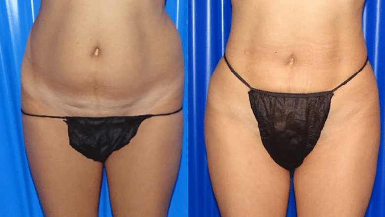 BBL before and after case 10 rear view