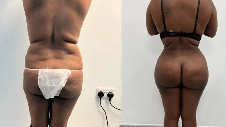 BBL before and after case 12