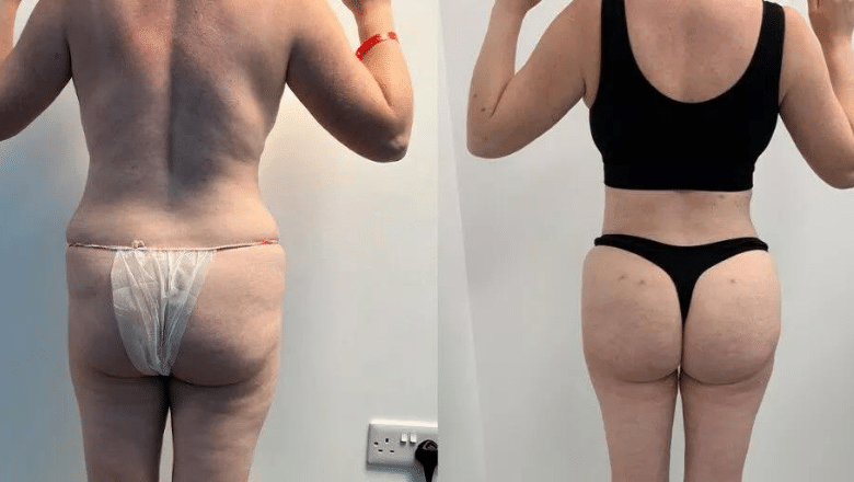 360 lipo and BBL before and after case 15