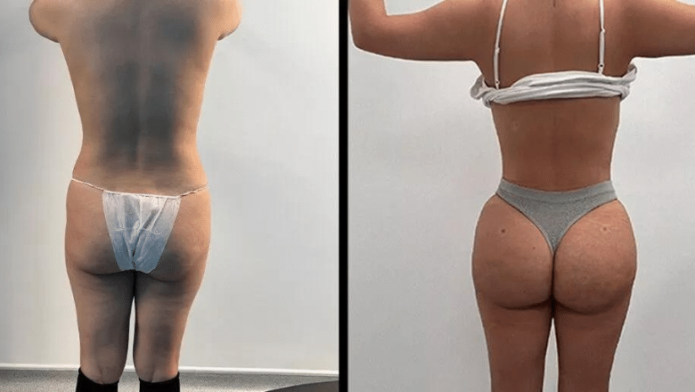 360 lipo and BBL before and after case 17