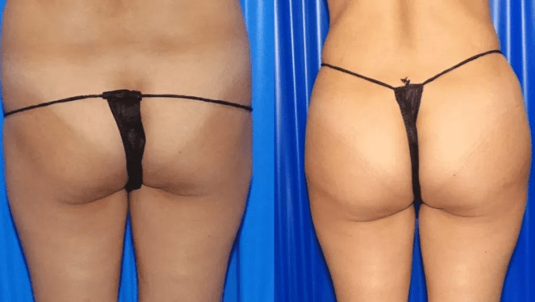 BBL before and after case 10