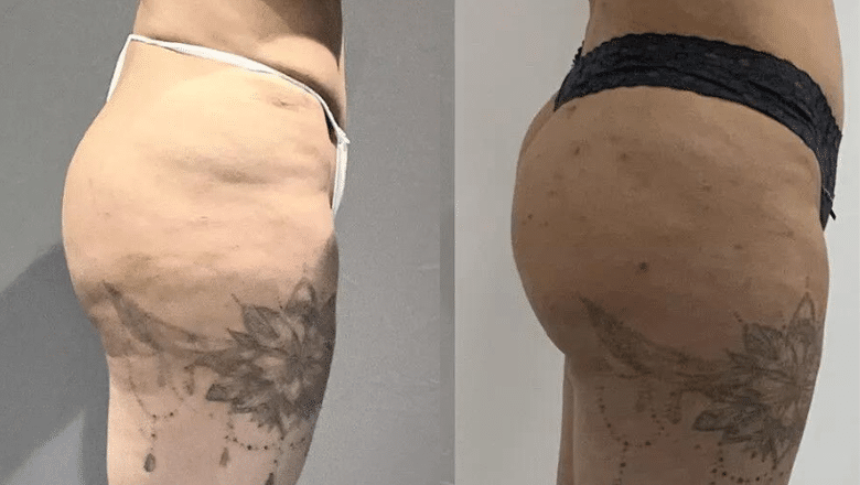 BBL before and after case 20 side view